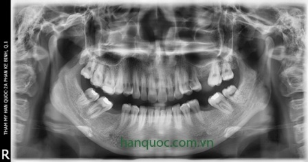 Phẫu thuật cắt hàm hô, móm 1 lần duy nhất - 5 Chụp phim X Quang kỹ thuật số Panorama