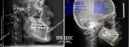 Phẫu thuật cắt hàm hô, móm 1 lần duy nhất - 6 Chụp phim X Quang kỹ thuật số Panorama