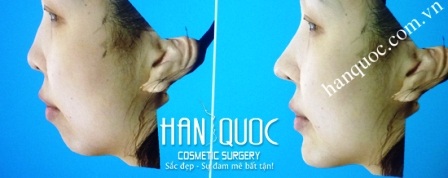 Phẫu thuật cắt hàm hô, móm 1 lần duy nhất - 7 Chỉnh sửa khuôn mặt theo công nghệ Vectra 3D duy nhất tại VN