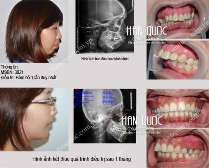 Phẫu thuật cắt hàm hô, móm 1 lần duy nhất - 8 Chỉnh sửa khuôn mặt theo công nghệ Vectra 3D duy nhất tại VN