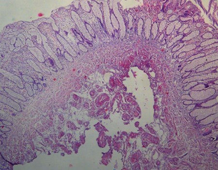 Khối u được cắt nhỏ ra và soi qua kính hiển vi, thấy rõ tận phần gốc của khối u