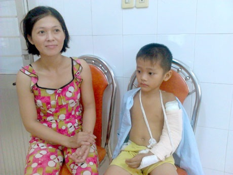 Trẻ gãy tay vì trượt patin - 1 Cháu L.T.P. với cánh tay băng bó sau tai nạn ở lò gạch
