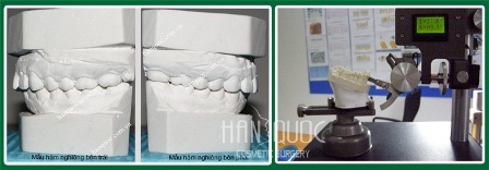 Phẫu thuật thẩm mỹ hàm hô vẩu (móm) - 3 Đổ mẫu 2 hàm và lên giá khớp