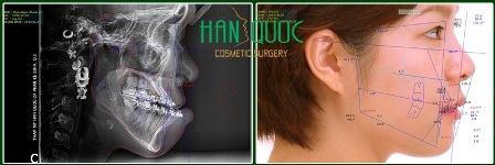 Phẫu thuật thẩm mỹ hàm hô vẩu (móm) - 5 Phim X Quang kỹ thuật số của P.T.K.T được phần mềm IP4 OSMS xử lý