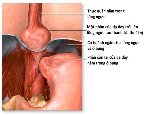 Ho ra máu do loét túi thoát vị dạ dày - 1 Hình minh họa cho bệnh thoát vị hoành