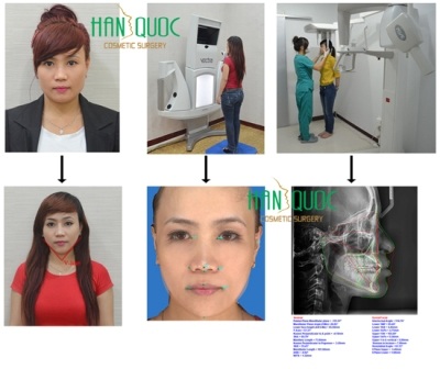Nâng mũi S-Line & khuôn mặt V-Line: Vẻ đẹp phụ nữ Việt - 3 Máy Vectra 3D phân tích đưa ra chiếc mũi theo tiêu chuẩn tỷ lệ vàng
