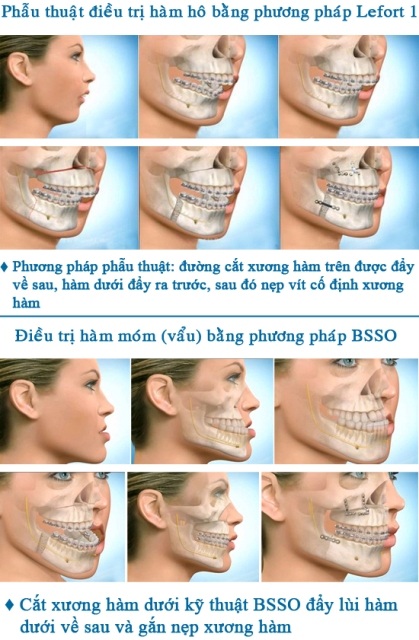 Phẫu thuật chỉnh hàm hô móm (vẩu) không cần niềng răng - 2 Phương pháp phẫu thuật hàm hô – móm (vẩu) tại Thẩm Mỹ Hàn Quốc – 2A Phan Kế Bính