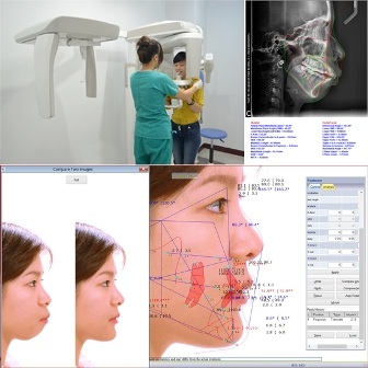 Phẫu thuật chỉnh hàm hô móm (vẩu) không cần niềng răng - 4 Quá trình chăm sóc sau phẫu thuật cũng là vấn đề