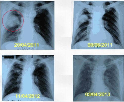 Đốt u phổi bằng sóng cao tần, hi vọng mới của bệnh nhân ung thư