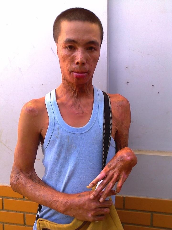 Anh Nguyễn Đức Ngan trước khi bị tai nạn bỏng