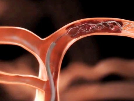 TS-BS Nguyễn Huy Thắng chia sẻ về phương pháp can thiệp nội mạch để cấp cứu đột quỵ