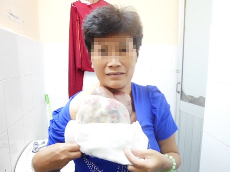 Ân hận vì biết ung thư vú từ sớm nhưng nhập viện muộn màng