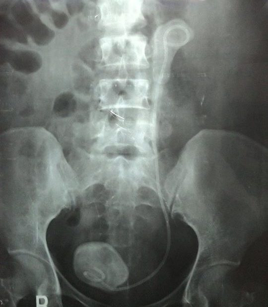 Thận nhiễm trùng vì ống thông nằm trong ổ bụng 5 năm - 1 Thận nhiễm trùng vì ống thông nằm trong ổ bụng 5 năm