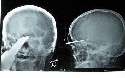 Cứu sống thiếu niên bị kiếm đâm sâu vào đầu - 1