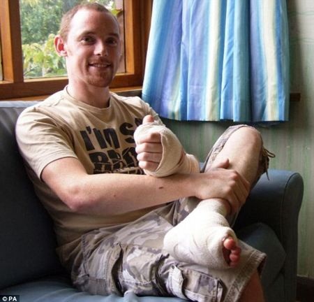 Dùng ngón chân cái để “thế” ngón tay cái - 2 Dùng ngón chân cái để “thế” ngón tay cái - 2