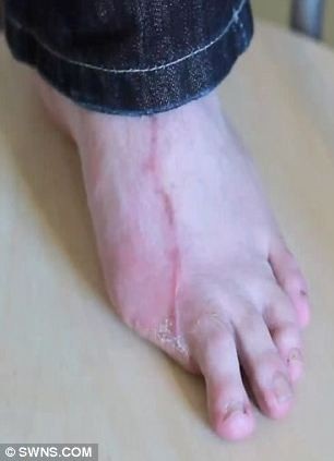 Dùng ngón chân cái để “thế” ngón tay cái - 3 Dùng ngón chân cái để “thế” ngón tay cái - 3