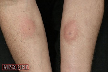 Cánh tay bị sưng tấy sau khi tiêm nọc rắn độc