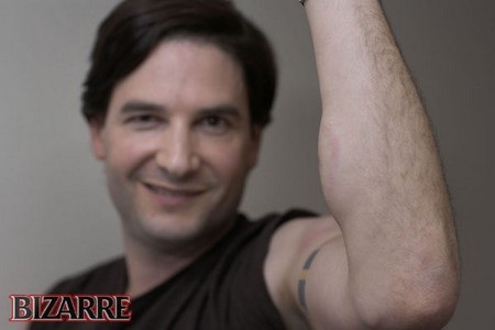 Cánh tay bị sưng tấy sau khi tiêm nọc rắn độc