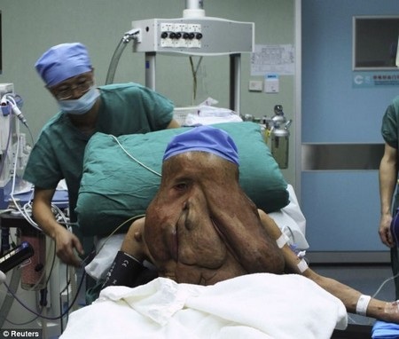 Gương mặt Huang Chuncai biến dạng hoàn toàn vì khối u khổng lồ