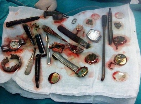 Trộm nuốt hàng loạt “chiến lợi phẩm” để phi tang vật chứng - 1 Những vật dụng kỳ lạ được lấy ra khỏi bụng Piotrowski