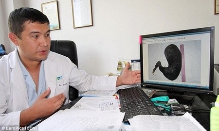 Bác sĩ phẫu thuật và bức ảnh chụp búi tóc bị mắc kẹt trong dạ dày bệnh nhân