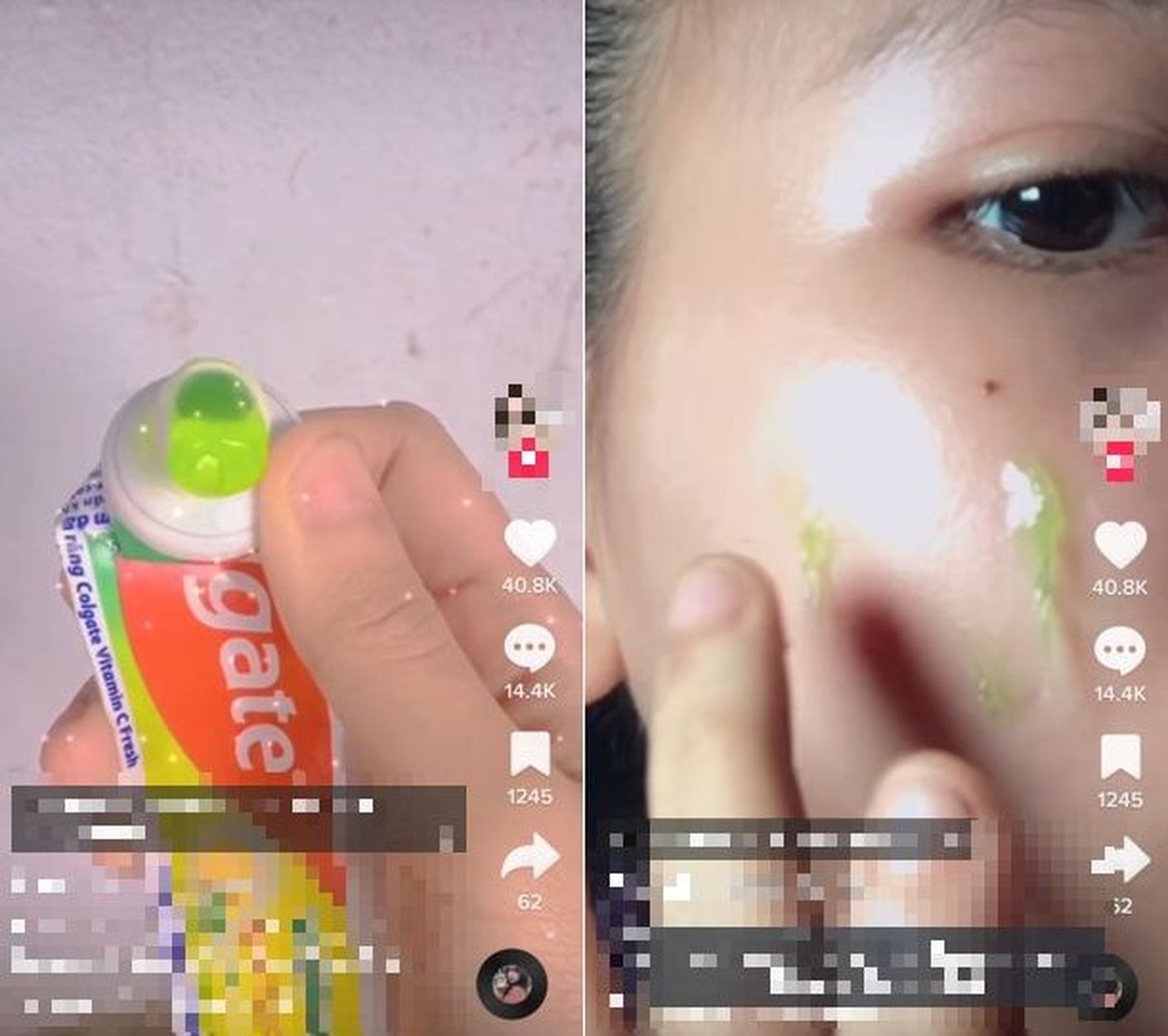 Nát mũi, hỏng mặt, biến chứng thai kỳ vì bác sĩ Tiktok - 7 Nát mũi, hỏng mặt, biến chứng thai kỳ vì bác sĩ Tiktok - 7