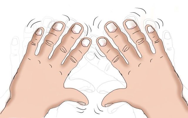 Hy vọng mới giúp bệnh nhân run tay lấy lại tự tin trong cuộc sống - 1 Bệnh run tay khiến người bệnh luôn lóng ngóng, vụng về ngay cả khi làm những việc đơn giản nhất như cầm ly nước, bưng chén cơm.