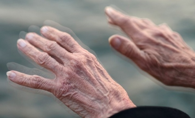 Thêm một phương pháp trong điều trị làm chậm tiến triển của bệnh Parkinson - 1 Bệnh Parkinson gây trở ngại lớn trong sinh hoạt cũng như công việc hàng ngày của người bệnh