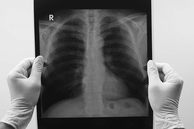 Vì sao không hút thuốc vẫn bị ung thư phổi? - 1 Hút thuốc lá không phải là con đường duy nhất dẫn đến ung thư phổi