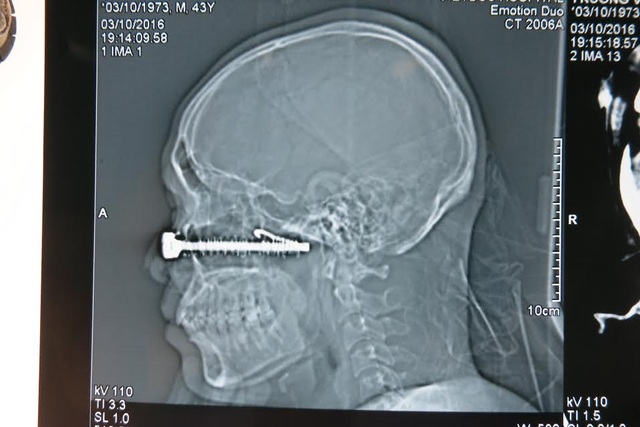 Chụp CT sọ não Ưu nhược điểm và cách tiến hành  TCI Hospital