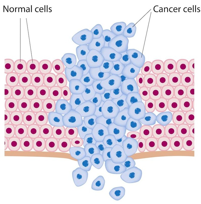 
Tế bào bình thường và tế bào ung thư.
