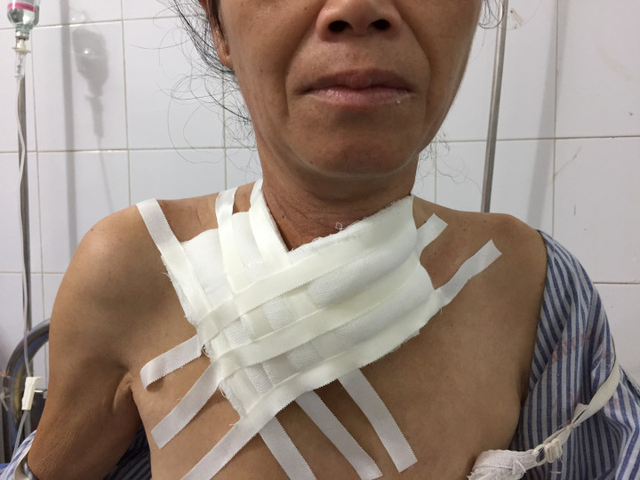 Bác sĩ khổ vì sửa sai cho thầy lang - 3 Hình ảnh bệnh nhân được rạch làm sạch ổ áp-xe cổ do dùng thuốc Nam. Ảnh: BVĐK Sơn La