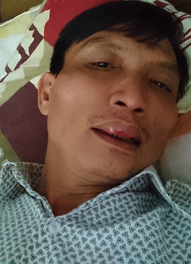 Bất đồng chuyện uống bia, Bí thư xã đánh bầm dập cán bộ - 2 Ông Hưng bị ông Truyền đánh bầm dập mặt. Ảnh ông Hưng cung cấp