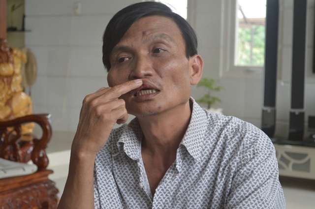 Bất đồng chuyện uống bia, Bí thư xã đánh bầm dập cán bộ - 3 Đến chiều 20-10 sau khi uống thuốc, gò má và môi ông Hưng đã bớt sưng