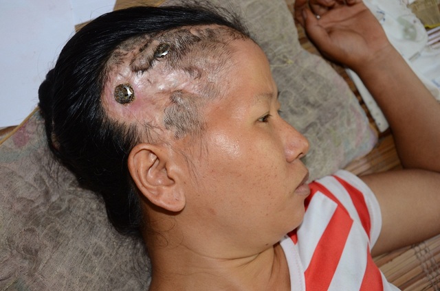 “Ai cứu mẹ con với, mẹ con chết mất thôi !…” - 1
Chị Khánh bị tai nạn nứt vỡ sọ, dập não phải