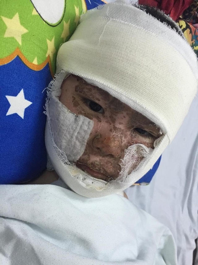 Bất ngờ nổ khí gas, 3 người trong gia đình bỏng nặng - 7 Tính mạng của con trai... như ngọn đèn trước gió.