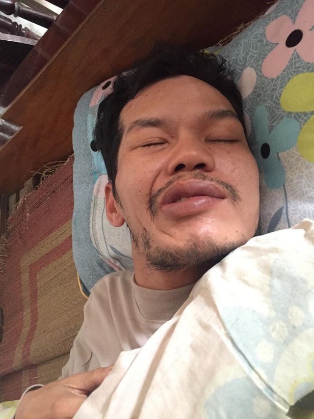 Mẹ bỏ đi, bố bị u não, bé gần 5 tháng tuổi ngằn ngặt khóc vì khát sữa - 2 Căn bệnh u não khiến người đàn ông mới 31 tuổi trở nên kiệt quệ.