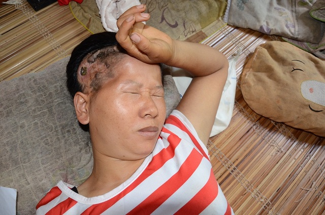“Ai cứu mẹ con với, mẹ con chết mất thôi !…” - 3
Vết thương ở đầu sau 5 năm không được chữa trị đến nơi đến chốn, nên hiện các cơn đau đầu liên tục hành hạ chị