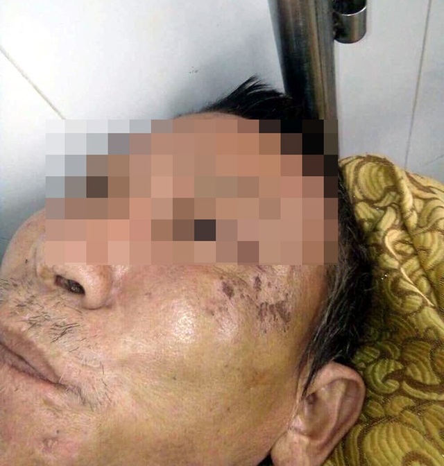 Ông N. bị con trai đánh đập trên mặt vẫn còn những vết thương chưa lành đang được điều trị tại bệnh viện.