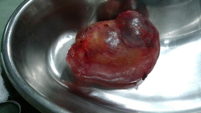 Bé trai vừa chào đời đã "mang thai" - 2
Bào thai ký sinh dài 7cm và có não