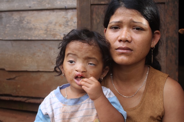 Đáng thương 2 anh em cùng mắc bệnh "suy tim, khiếm thị, hở hàm ếch" - 3 Nước mắt người vợ trẻ mong muốn các con được chữa bệnh, được đến trường như các bạn