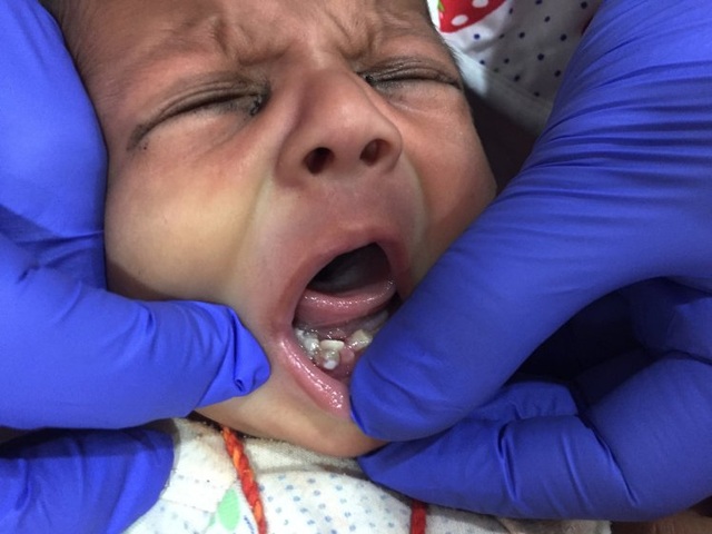 Em bé đầu tiên trên thế giới mới lọt lòng mẹ đã có 7 răng - 1