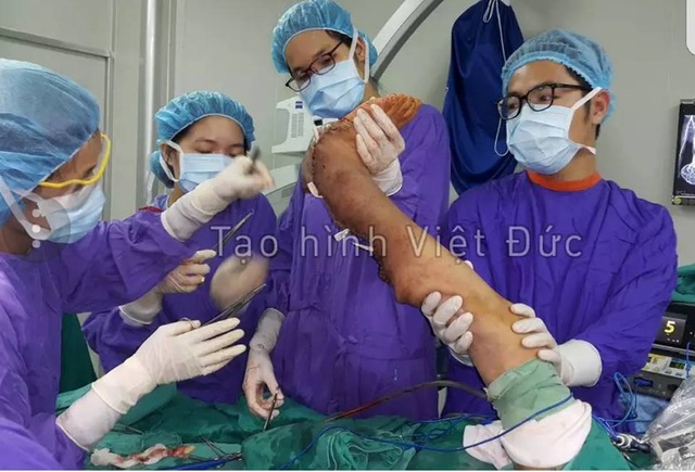 Giải cứu người phụ nữ hơn 39 năm mang “bàn chân voi” khổng lồ nặng 10kg - 3 Giải cứu người phụ nữ hơn 39 năm mang “bàn chân voi” khổng lồ nặng 10kg - 3