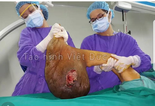 Giải cứu người phụ nữ hơn 39 năm mang “bàn chân voi” khổng lồ nặng 10kg - 2 Giải cứu người phụ nữ hơn 39 năm mang “bàn chân voi” khổng lồ nặng 10kg - 2