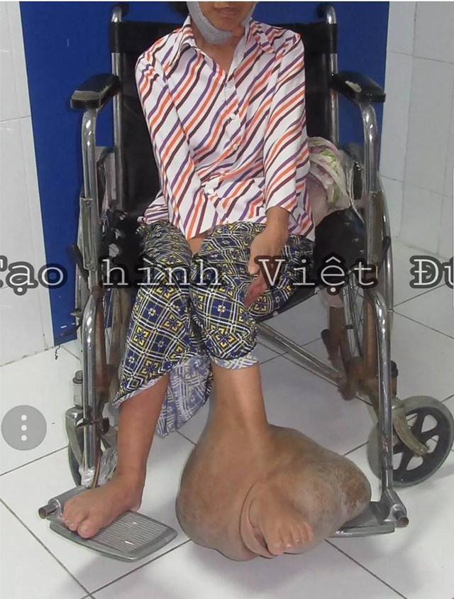 Giải cứu người phụ nữ hơn 39 năm mang “bàn chân voi” khổng lồ nặng 10kg - 1 Bàn chân với khối u to khổng lồ làm chị không thể đi lại. Ảnh: BS cung cấp.