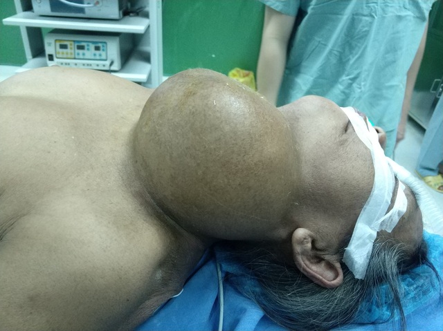 Cắt thành công khối u to như quả bưởi nằm trên cổ - 1 Khối u trên người bệnh nhân trước mổ