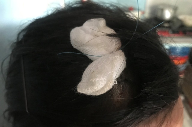 Người phụ nữ bị chém, cướp vé số: “Tôi không thể tưởng chúng tàn ác đến thế?” - 3 Vết thương khâu 6 mũi trên đầu của nạn nhân do bọn cướp gây ra.