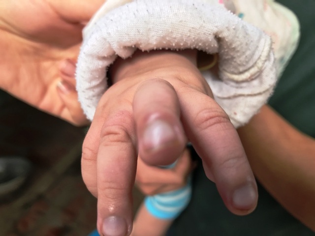 Bé 7 tháng tuổi nguy kịch vì bố mẹ không xoay được tiền mổ tim cho con - 3 Đến tay của bé Hà cũng sưng và thâm tím