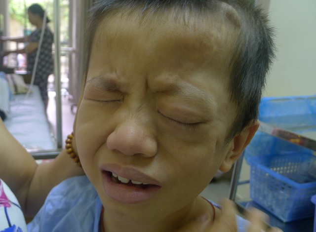 Bé 8 tuổi nguy kịch tính mạng vì phình động mạch cảnh khổng lồ - 1 Bị phình động mạch cảnh trong khổng lồ với kích thước từ 10.12cm khiến tính mạng của cậu bé Hoàn vô cùng nguy kịch.