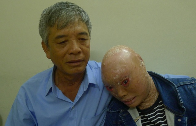 Em Hằng được bệnh viện Mắt Trung ương mổ miễn phí - 3 Được sự giúp đỡ của bạn đọc Dân trí và đặc biệt là các bác sĩ khoa Phẫu thuật thẩm mỹ và Gây mê của bệnh viện Mắt TW, em đã được phẫu thuật ngày 22/6.